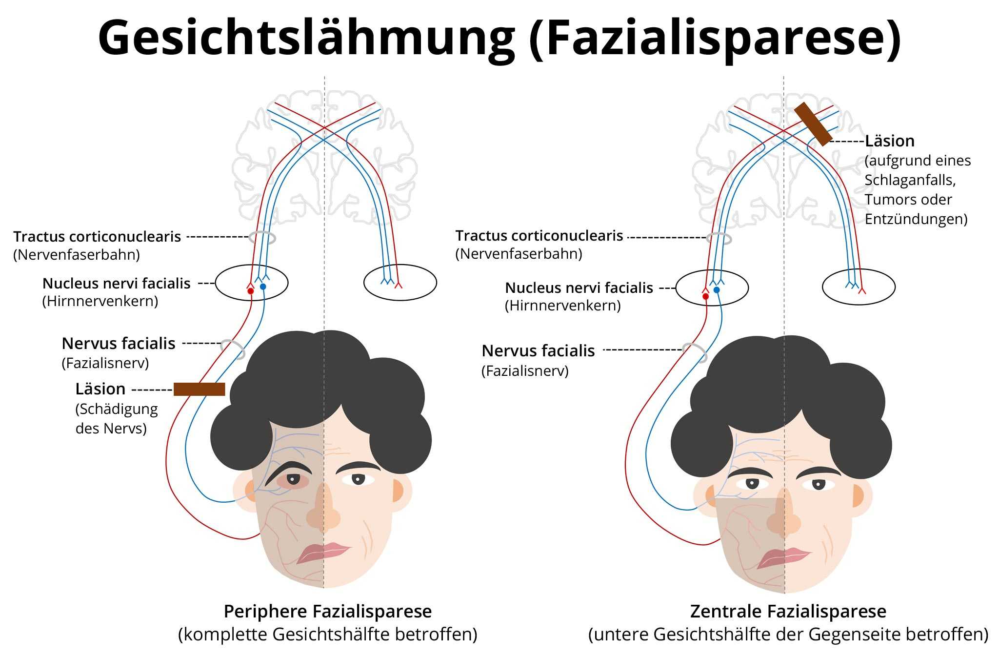 Gesichtslähmung Fazialisparese Anzeichen Therapie