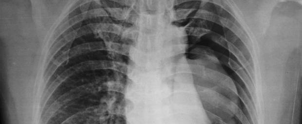 Wie Kann Man Einen Pneumothorax Verhindern