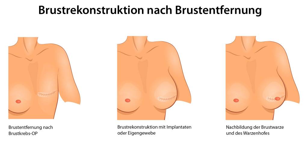 Brustkrebs sehr kleine brust