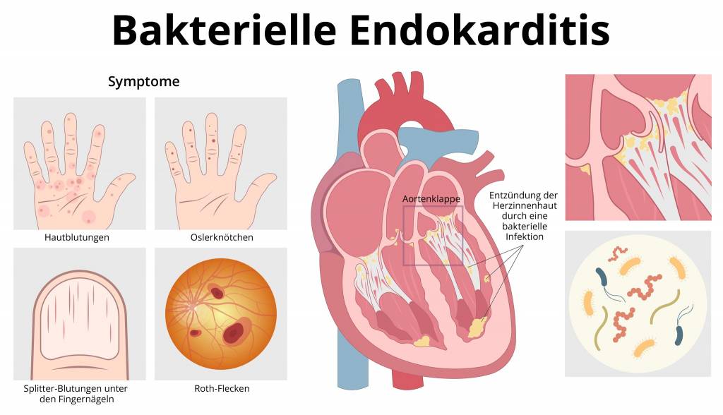 Endokarditis - die Entzündung der Herzinnenhaut