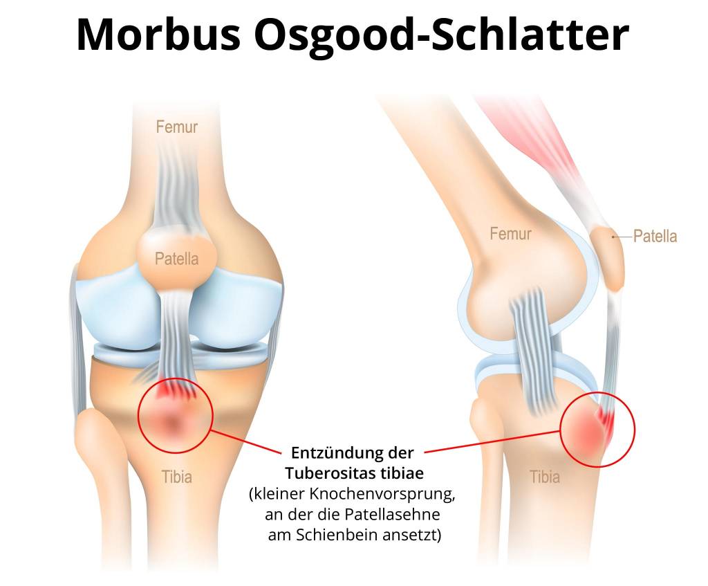 Morbus Osgood-Schlatter » Ursachen, Symptome, Behandlung