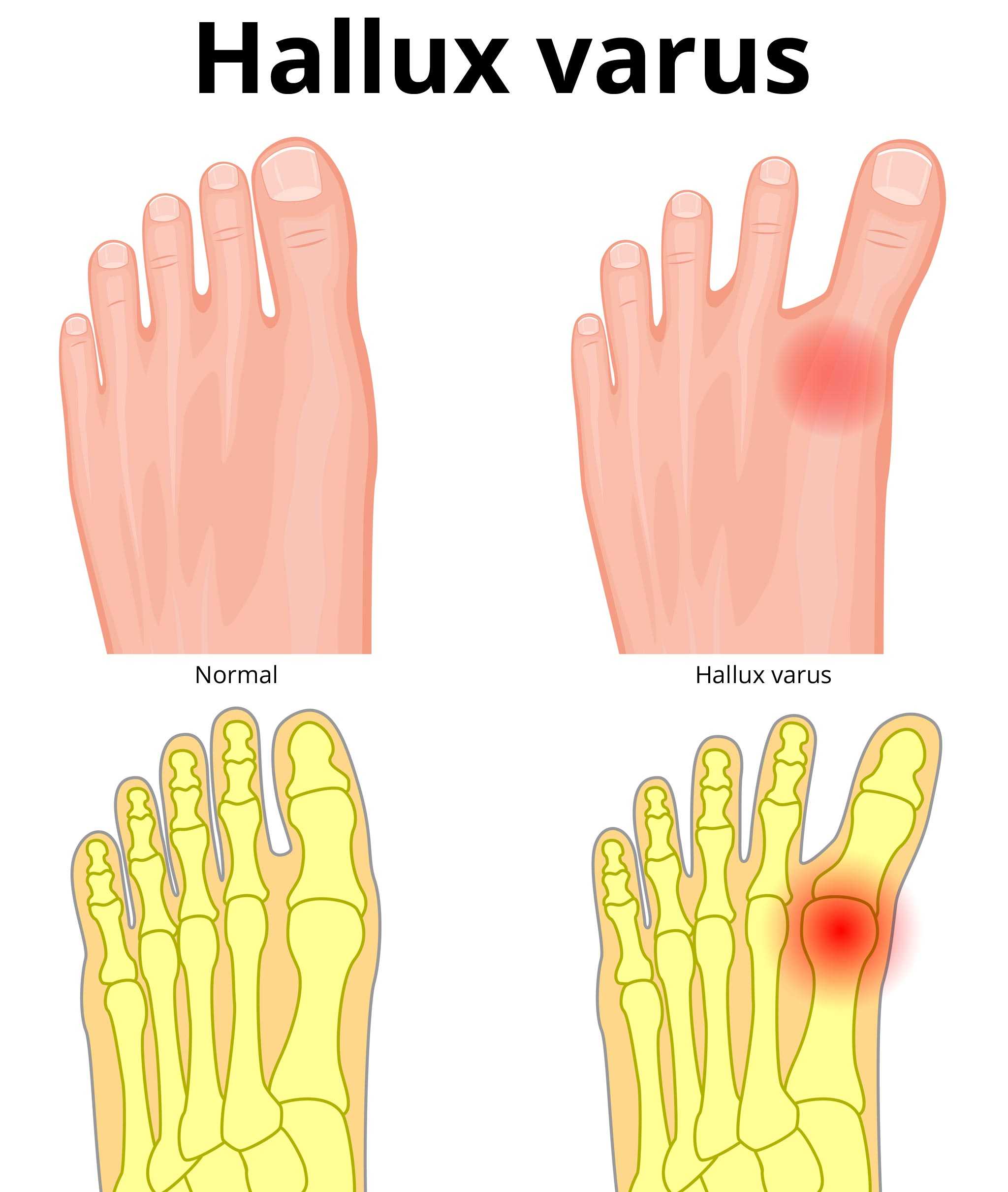 hallux-varus-ursachen-symptome-behandlung-prognose