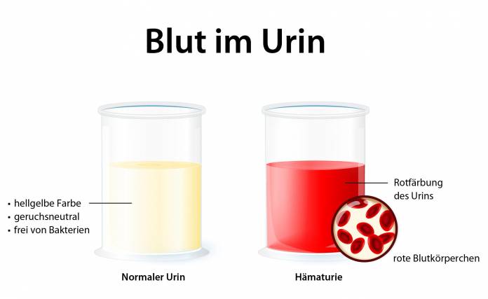 Blut im Urin (Hämaturie)