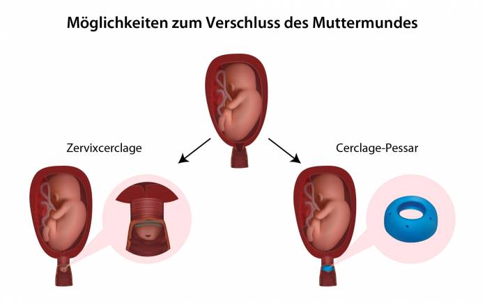 Cerclage bei vorzeitiger Muttermundöffnung
