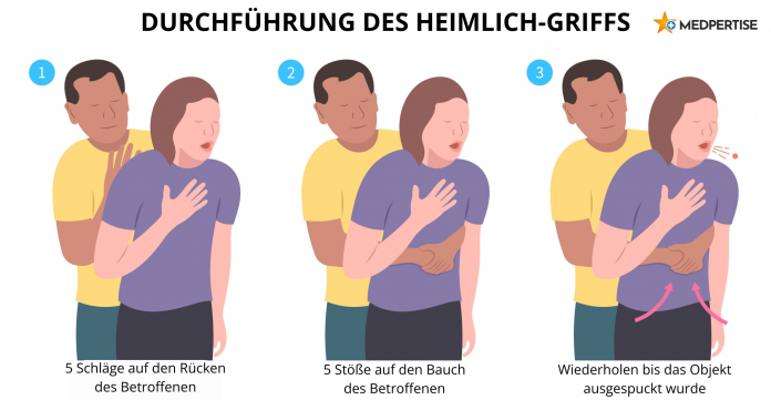 Durchführung des Heimlich-Griffs