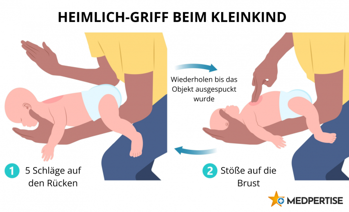 Heimlich-Griff beim Kleinkind