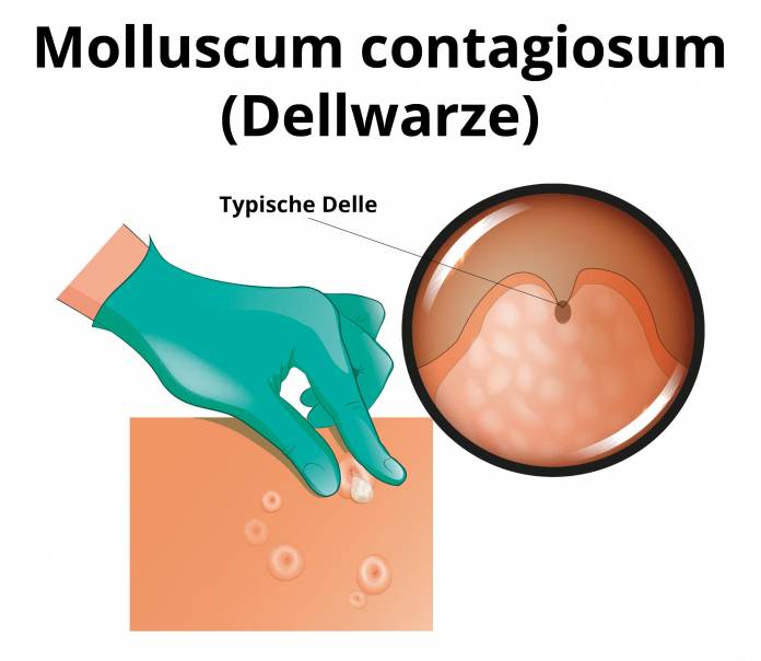 Molluscum contagiosum